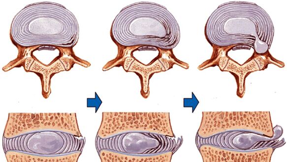 osteokondrozda omurga yaralanması