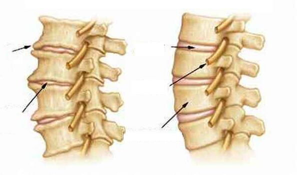 Osteokondroz nedir