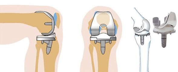 Arthroz için diz ekleminin endoprostetik çalışması
