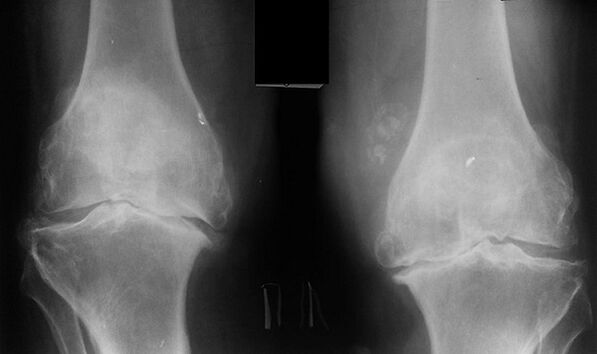 Diz ekleminin artrozunu teşhis etmenin bir yolu olarak x -Ray