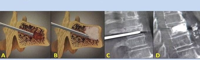 sırt ağrısı için delinme vertebroplastisi