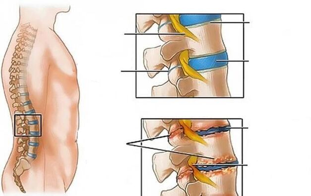 lomber omurganın osteokondrozu sırt ağrısına neden olur